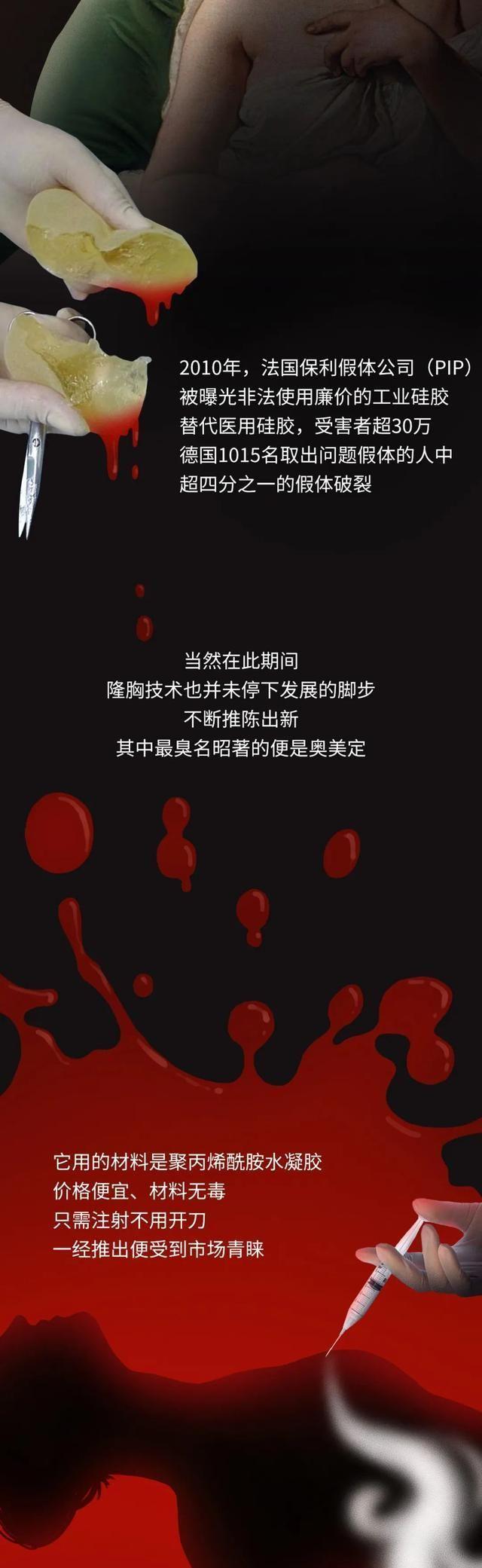 第一个隆胸的女人,第一个假体隆胸的人