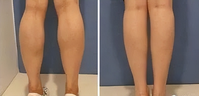 女生小腿肌肉怎么瘦医美,女孩小腿肌肉发达如何变细腿