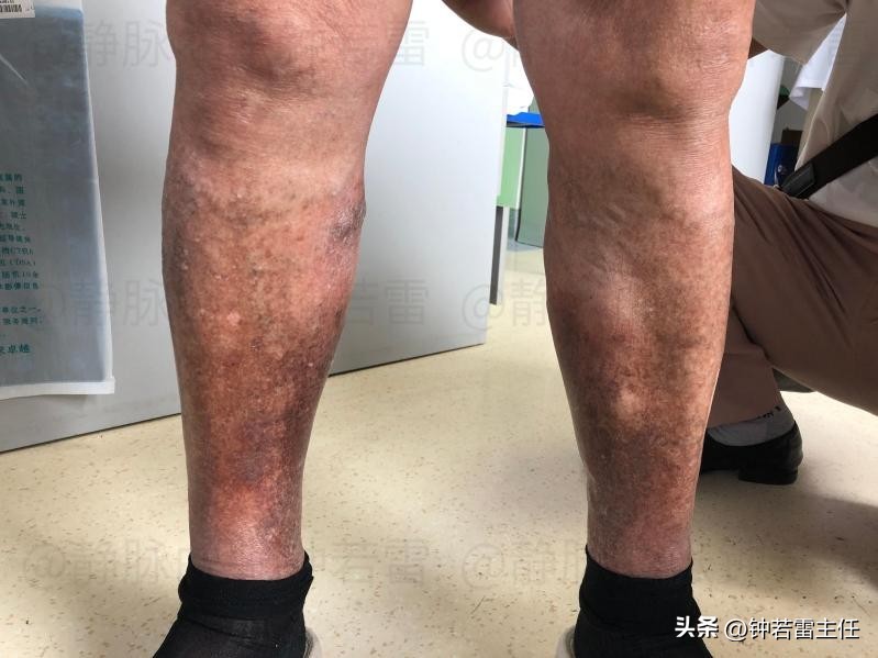 老烂腿早期治得好吗,四处求医的经历