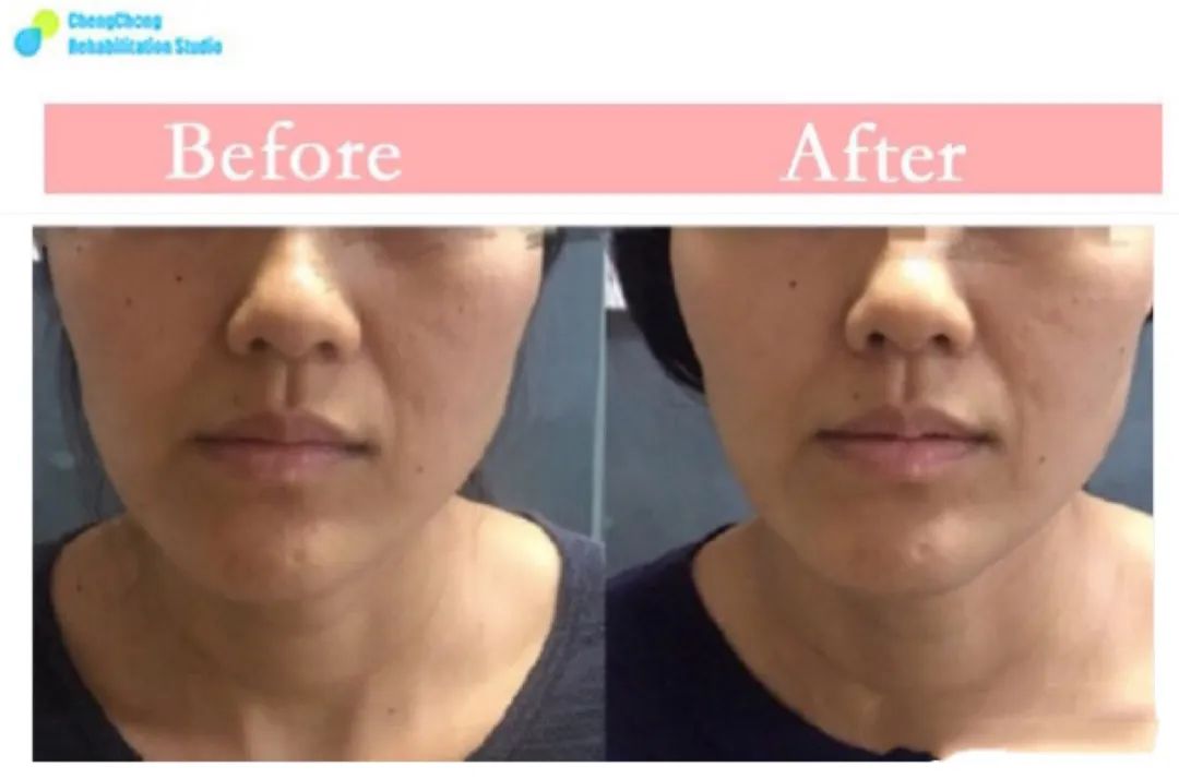 下颌骨歪斜引起脸歪图片,下颌歪斜导致大小脸怎么办