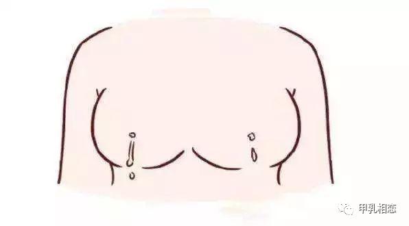 突然发现乳头大量流水，惊慌失措没必要，精准判断是关键