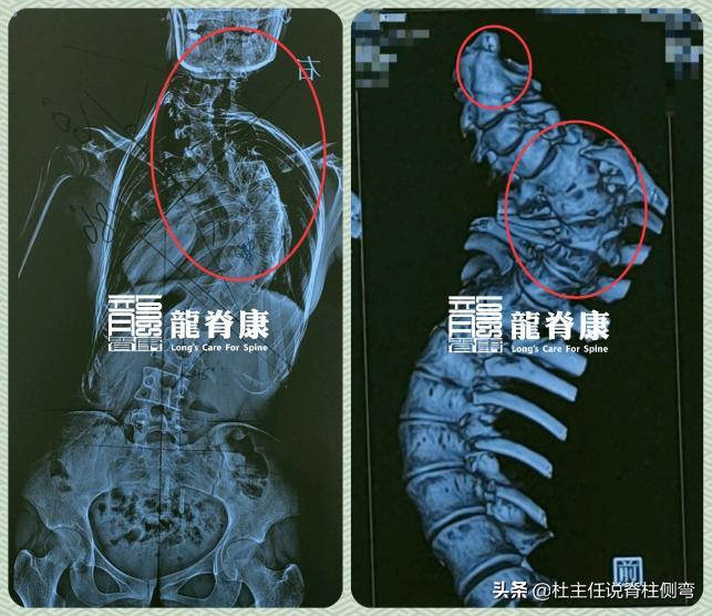 什么是先天性脊柱侧弯,先天性脊柱侧弯手术费用报销吗