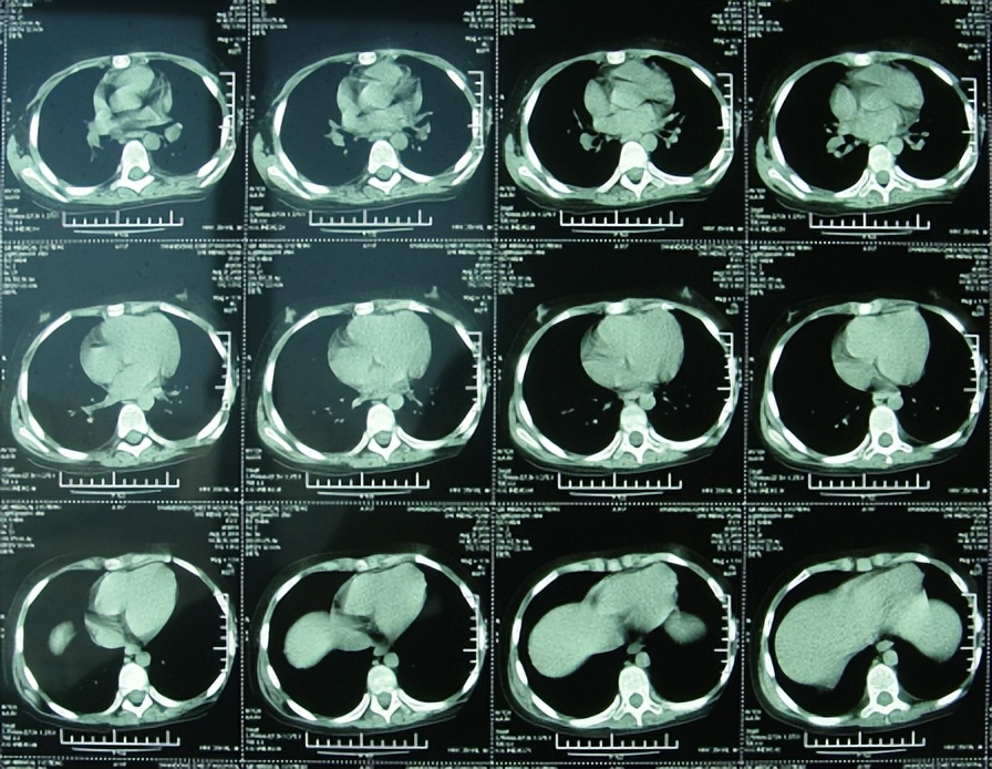 儿童结核脑膜炎脑积水,结核性脑膜炎脑积水如何引起