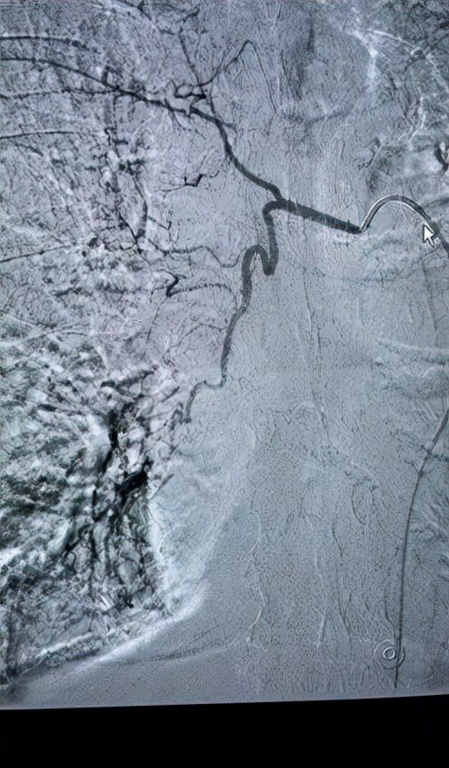 支气管动脉栓塞最严重术后并发症,支气管扩张并咯血的介入栓塞治疗