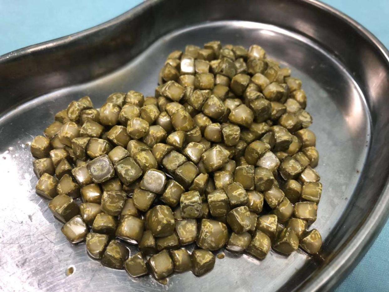 结石的治疗方法和饮食,结石可以通过吃什么缓解