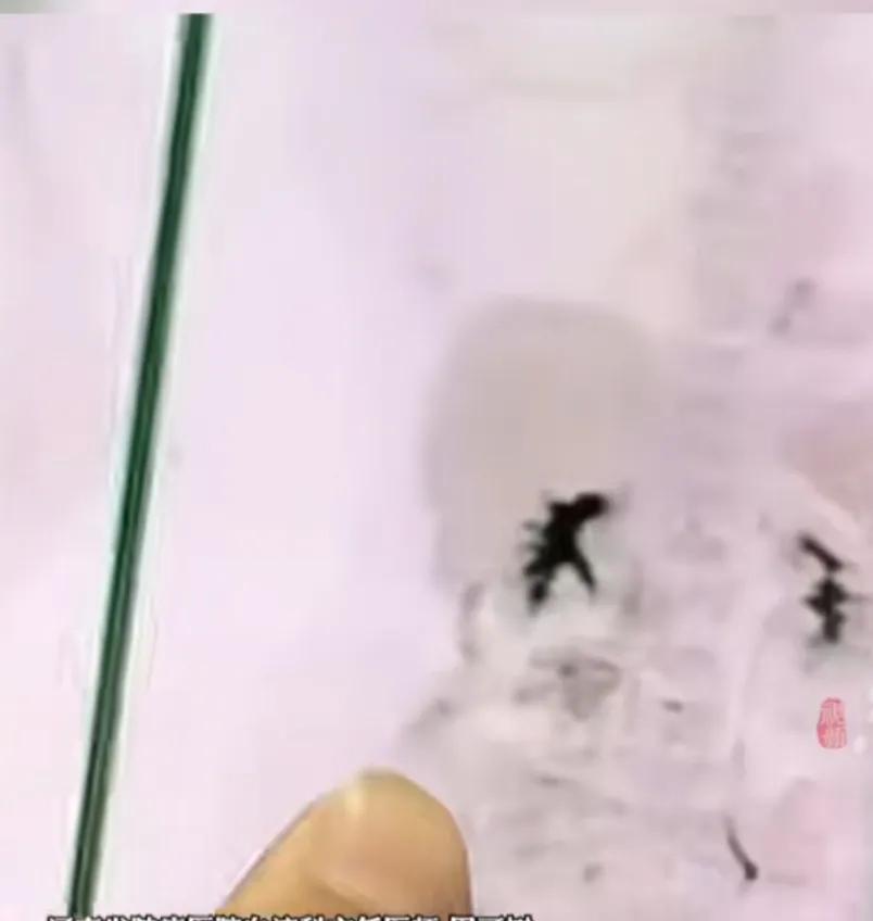 癌症针上市一针120万