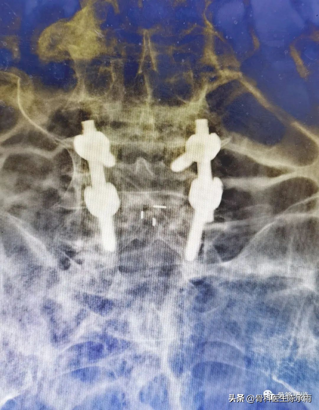 腰椎滑脱椎管狭窄手术后遗症,腰椎间盘突出椎管狭窄的手术