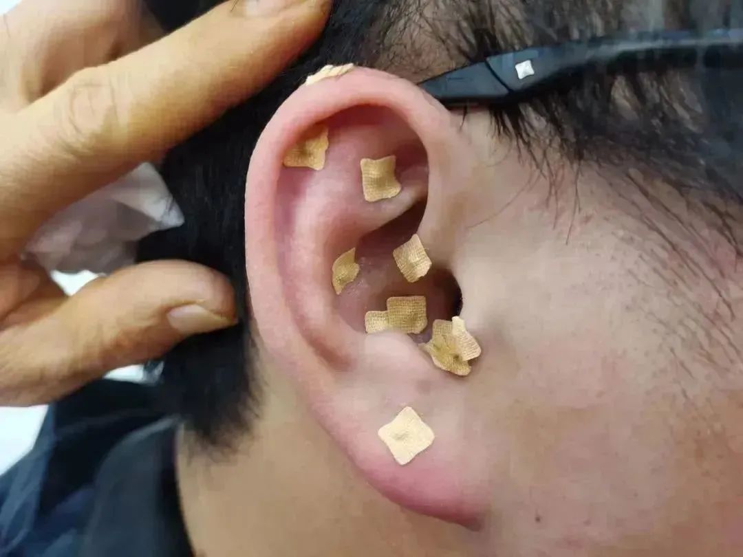 耳朵会说话|阳羡安仁坊耳穴疗法公益培训小记