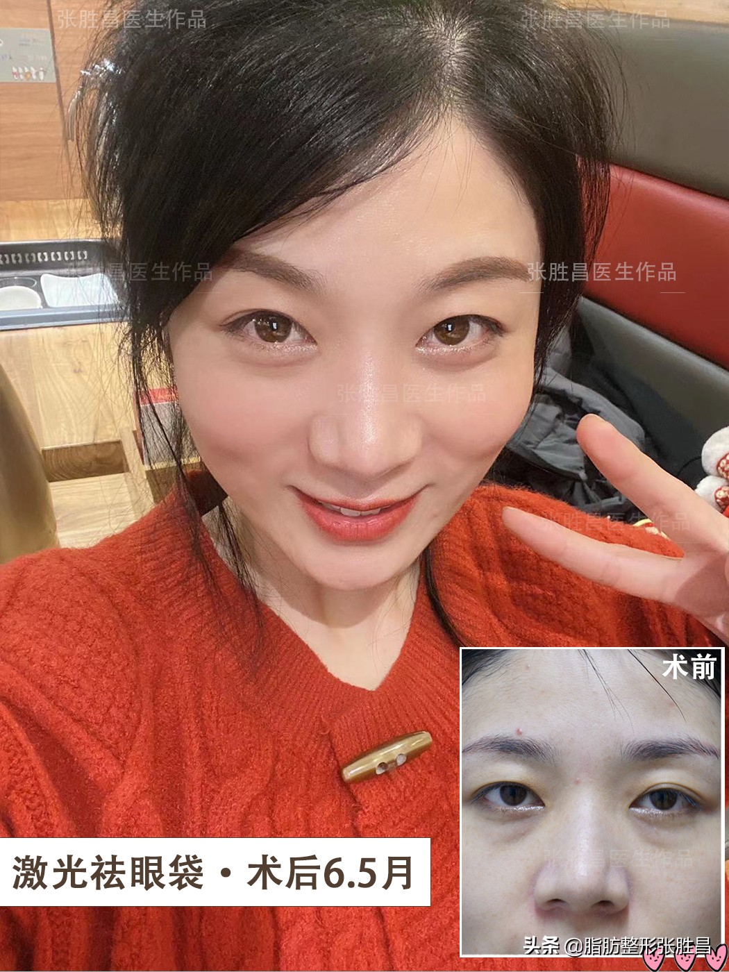 外切祛眼袋会去掉卧蚕吗,去眼袋会把卧蚕去掉吗