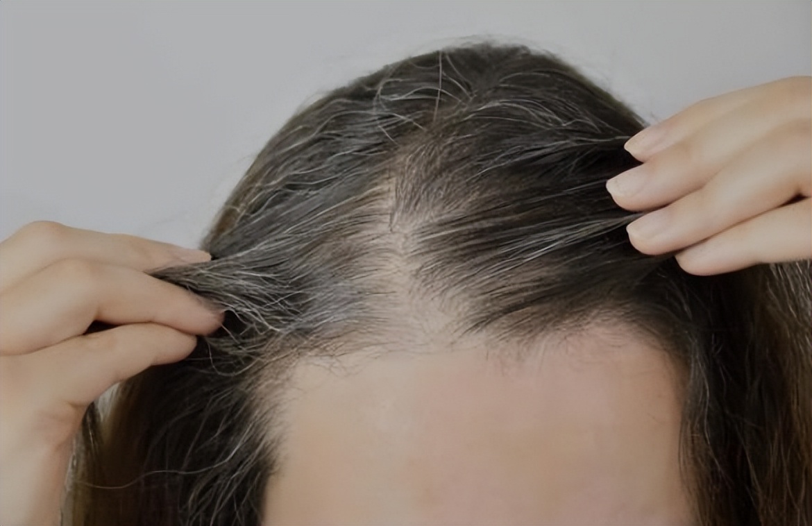 年轻白头发是缺少什么营养,年轻人白头发是一般营养不足吗