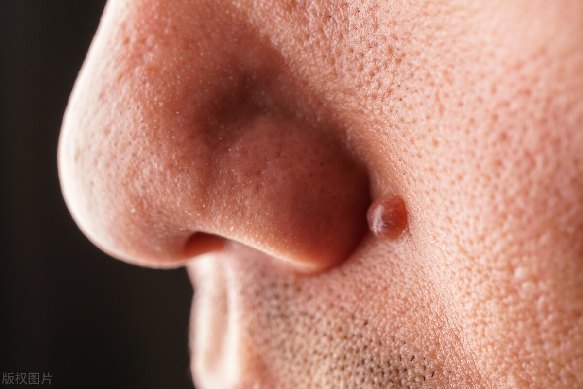 黑痣越来越多是癌吗,黑痣会越长越多吗