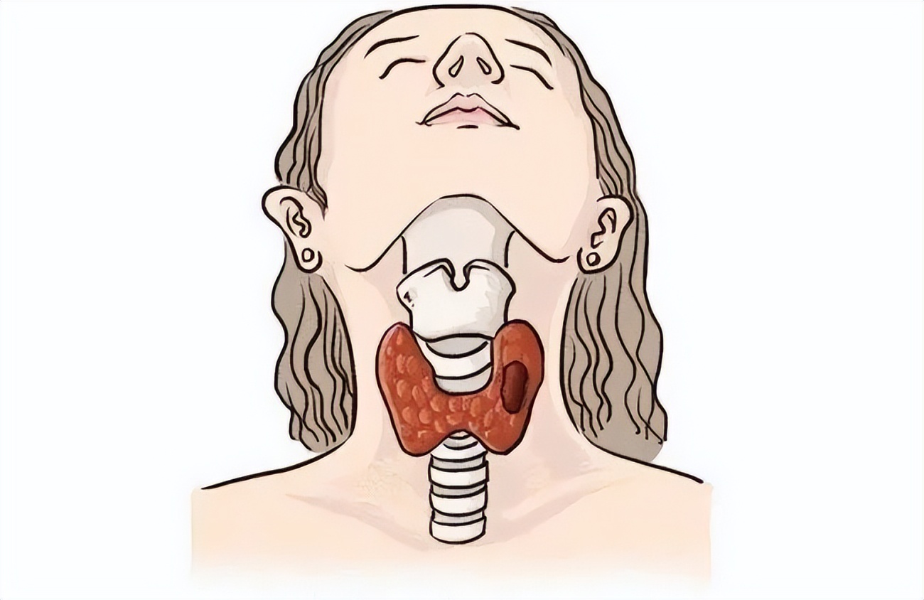 甲状腺癌是“懒癌”?别低估其破坏力