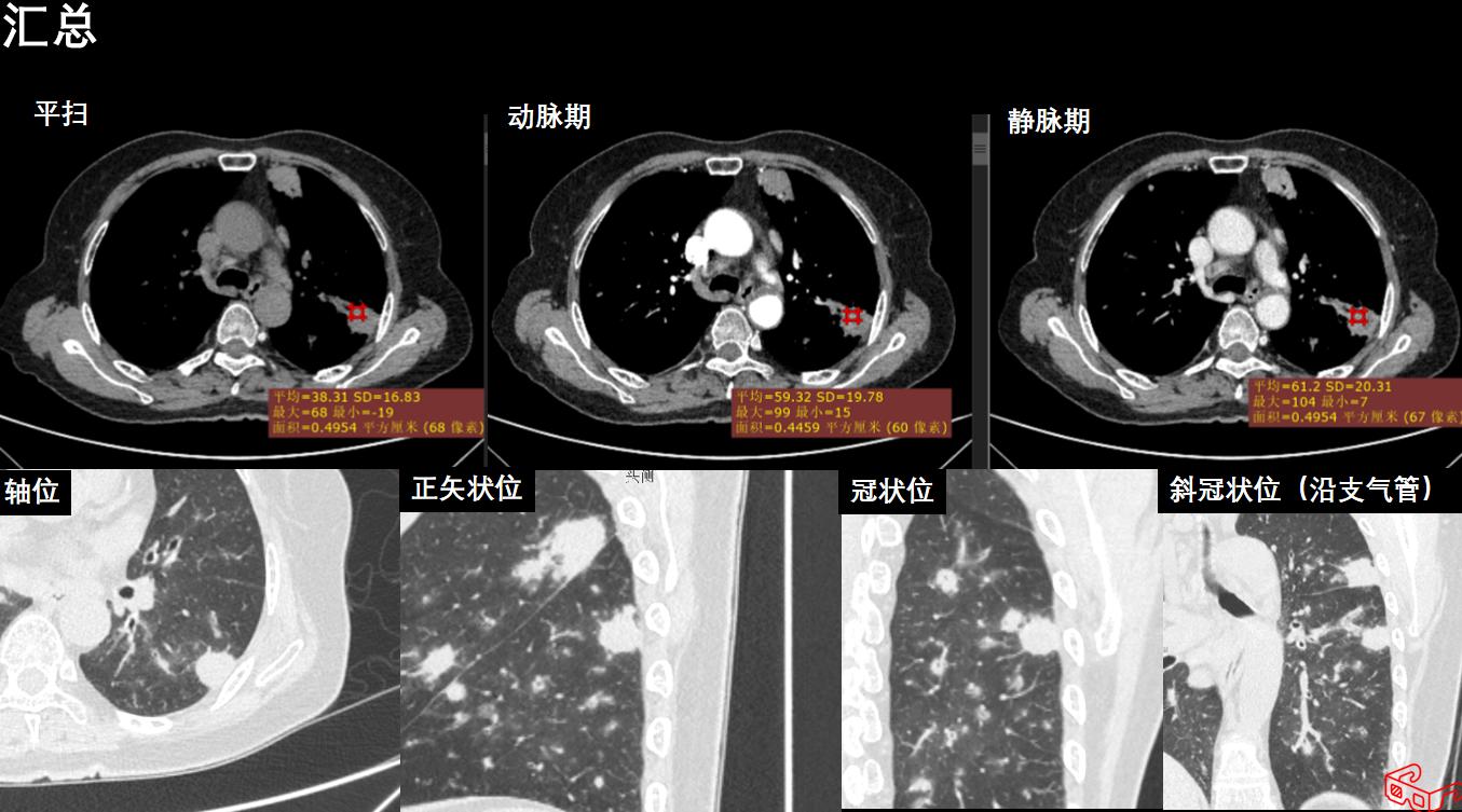 肉芽肿性血管炎ct表现,嗜酸性肉芽肿性血管炎症状