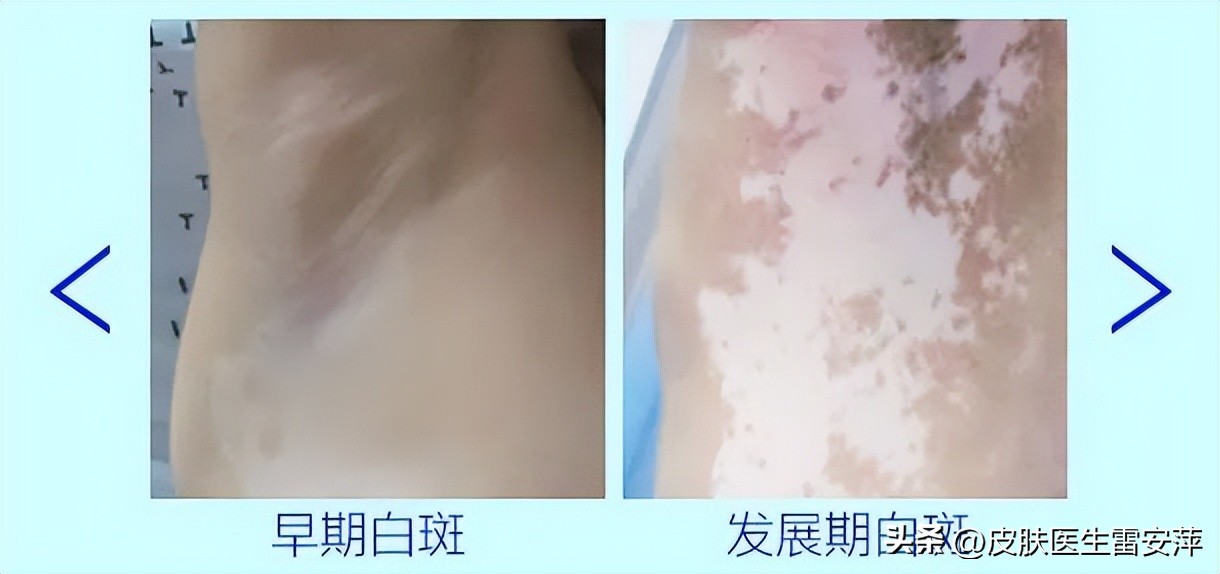 皮肤上突然黄了一块,突然有块地方变白是白癜风吗
