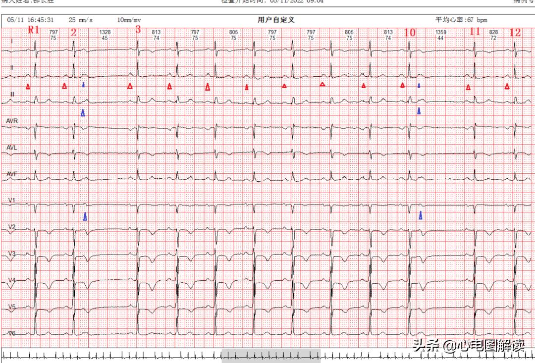 心电图rr间期长有危害吗,心电图短pr间期产生原因