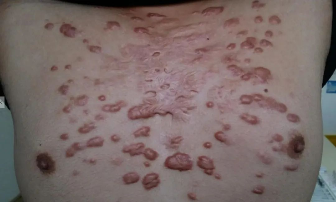 阳春三月｜你的疤痕疙瘩瘙痒难耐怎么回事？