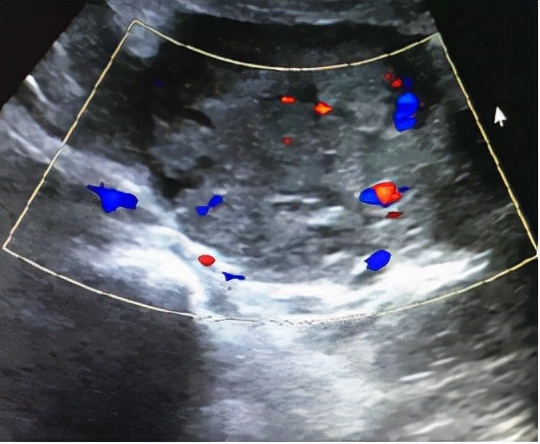 双胞胎隔“宫”相望，医生“攘外安内”