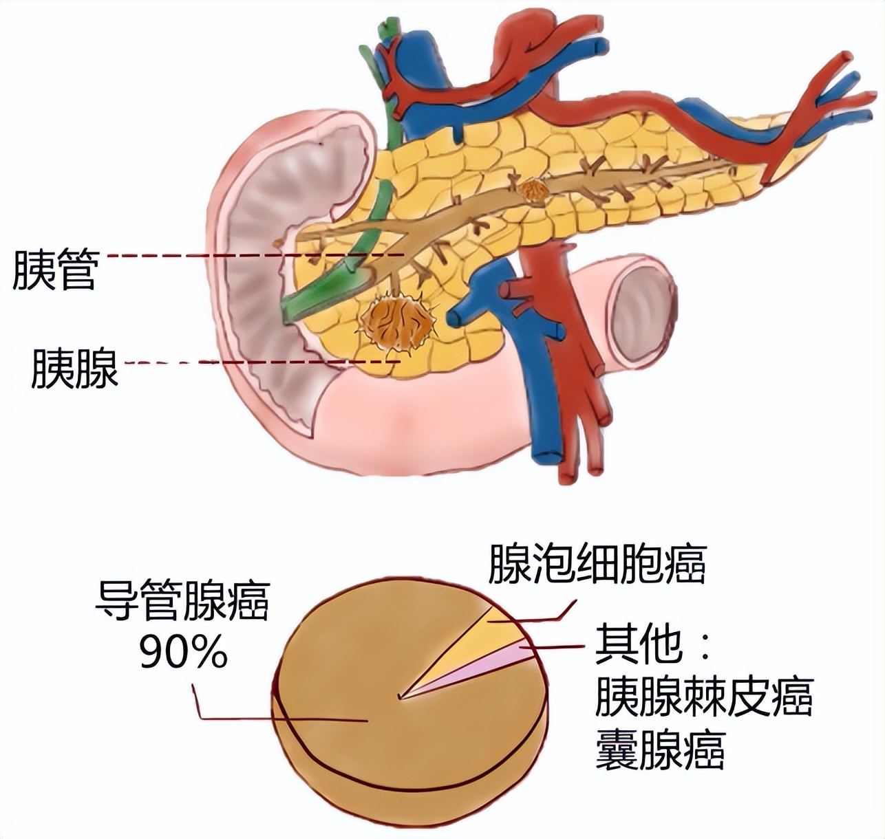 “隐藏高手”胰腺癌的新出路——微生物