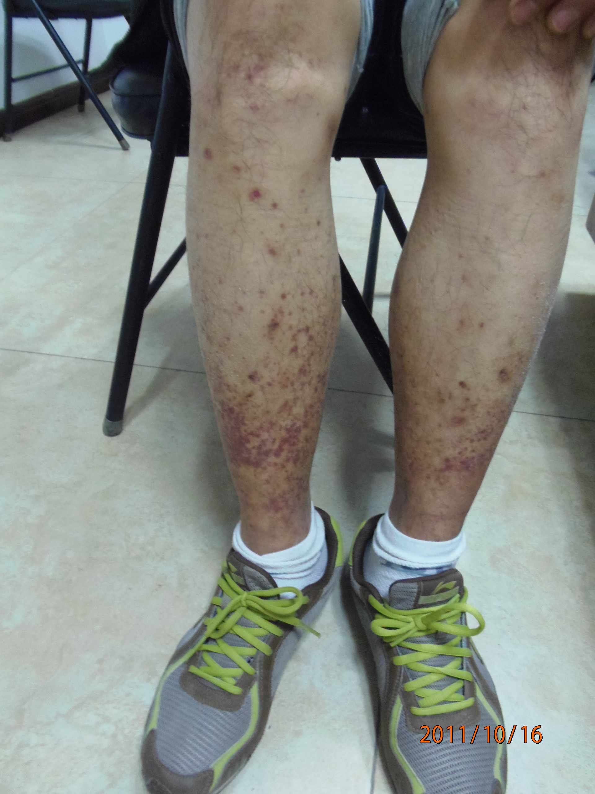 手上有红色的小点点过敏性紫癜,腿上有小红点皮下出血