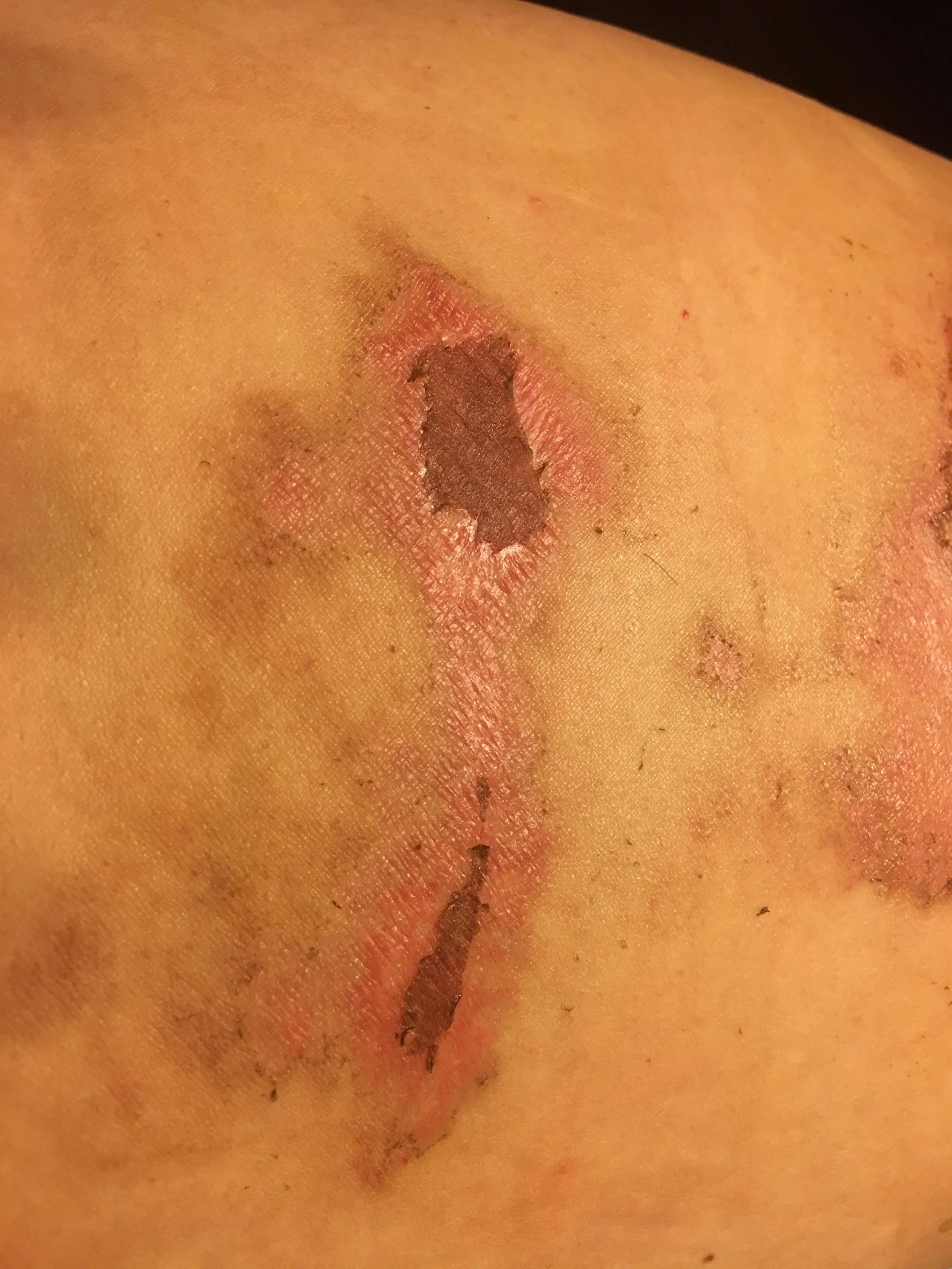 烫伤后的正确处理方法就这五个字,知识分享烫伤后的正确处理方式