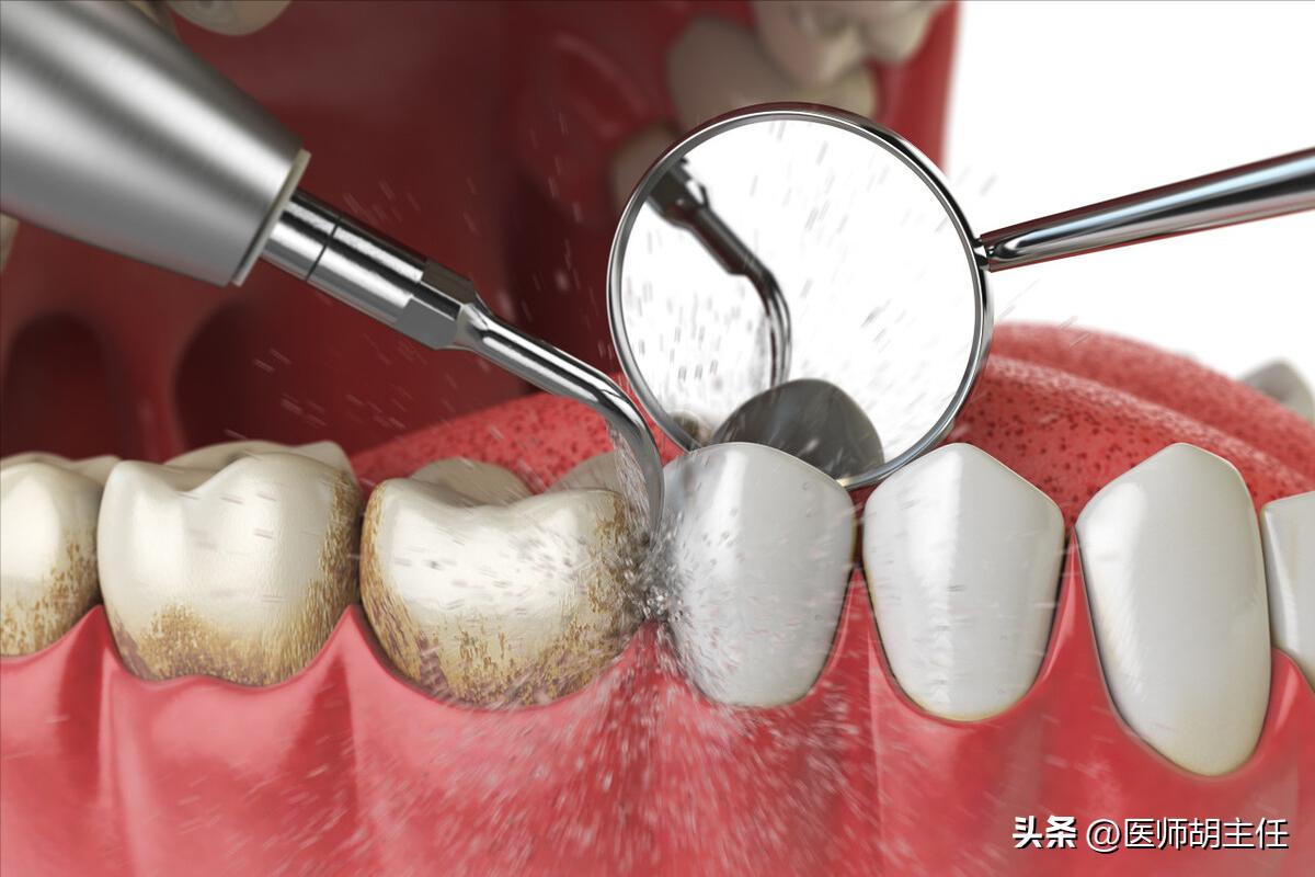 牙缝中的牙结石怎么去除,牙缝的牙结石怎么自己去除