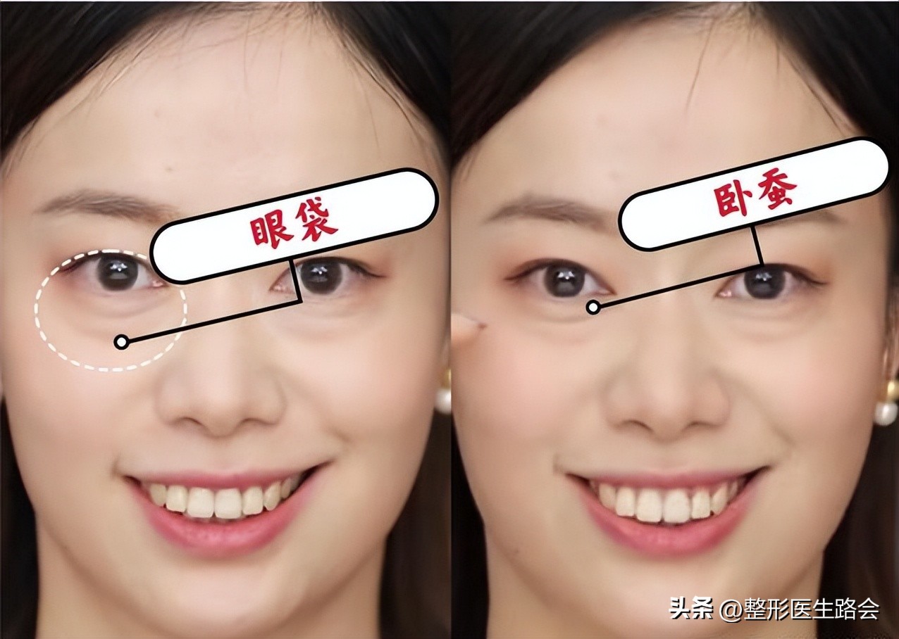 眼袋和卧蚕的区别看完你就知,怎么分清眼袋和卧蚕的区别图片
