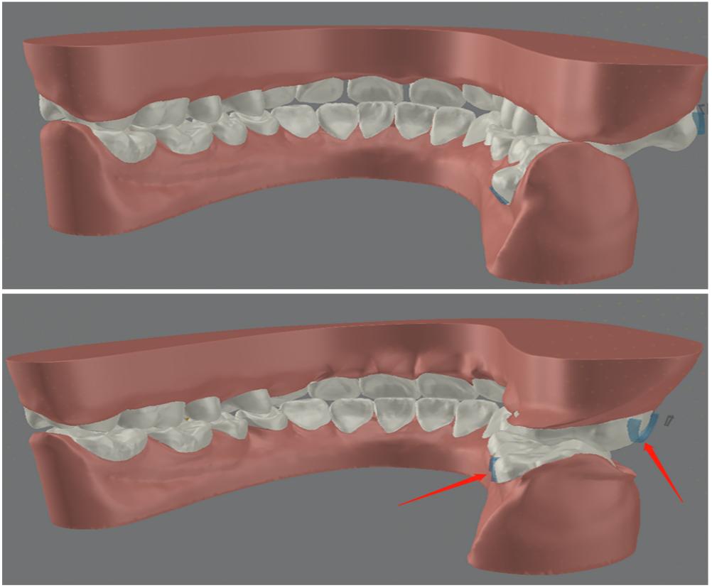 无托槽隐形矫治流程,隐形矫正早期干预