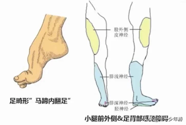 周围神经病和外周神经病,周围神经病