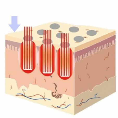 医学那么发达为什么治不了痘坑,想治痘坑但没钱怎么办