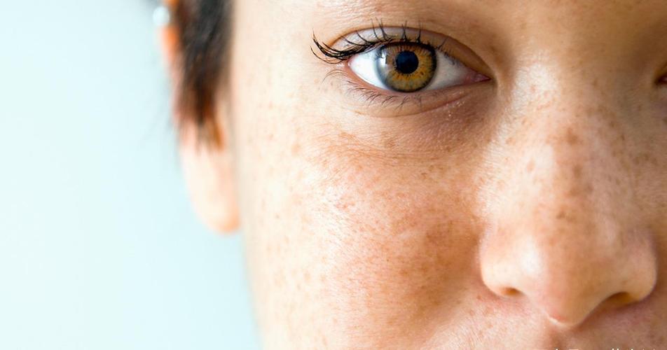 老年斑为什么会越来越大颜色变深,年轻长老年斑的原因以及解决方案