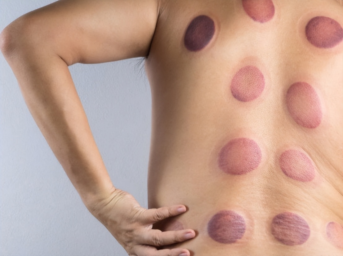 拔火罐吸出来的淤血，是体内的毒素？告诉你真相，看完涨知识