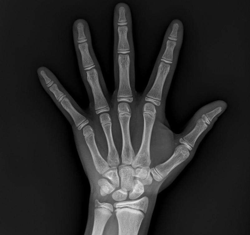 16岁孩子骨龄闭合如何长高,骨龄偏大如何补救预测身高偏矮