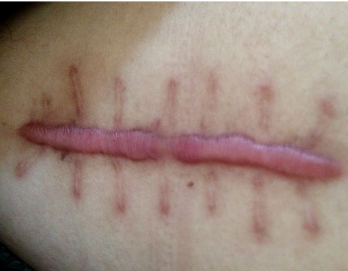 鼻头长黑粉刺怎么回事图片,鼻梁及两侧起了闭口粉刺