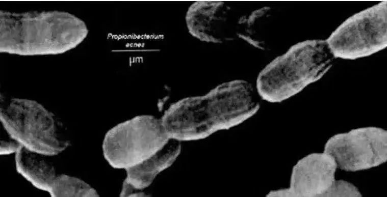 痘痘反复长测一测教你正确祛痘,痘痘反复长你知道这个祛痘方法吗