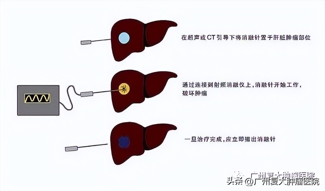 肝肿瘤靠近心脏，微波如何消融？