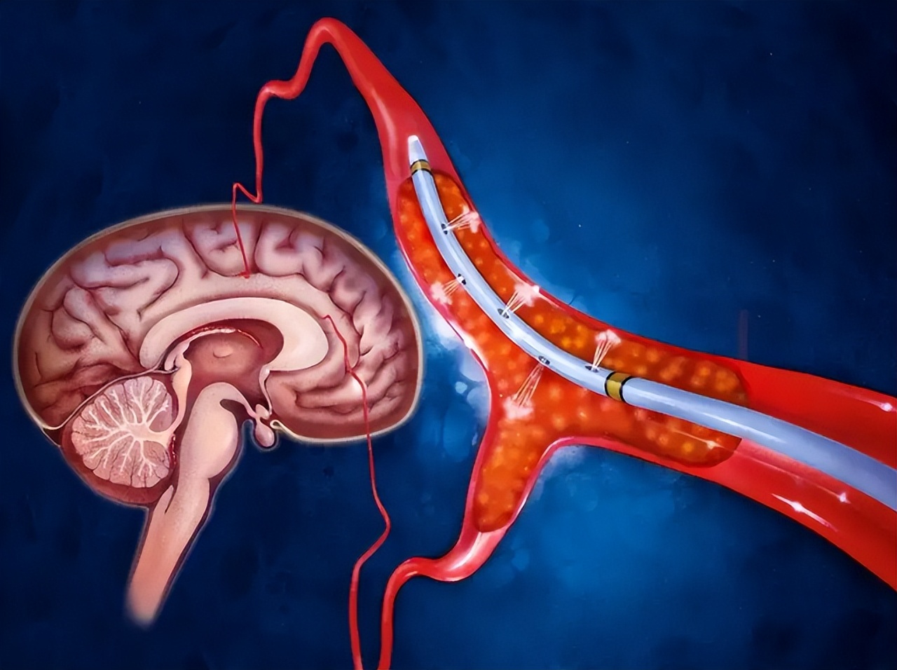 卵圆孔未闭无症状要治疗吗？