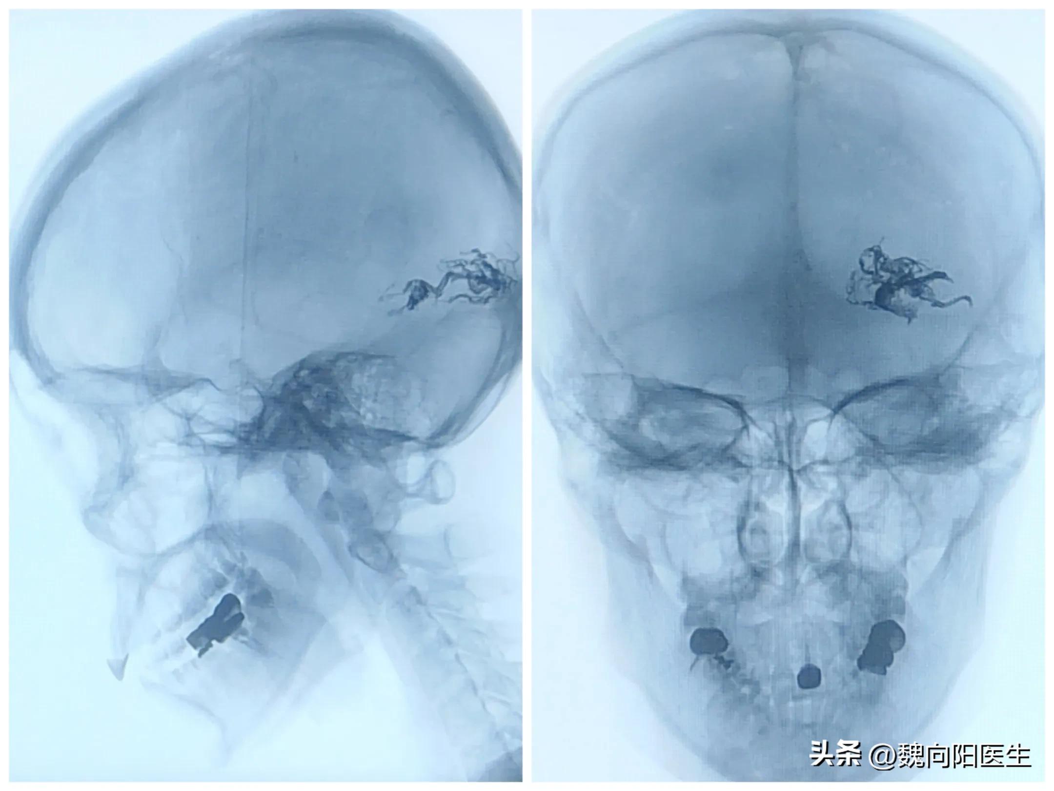 脑出血后的患者,脑出血患者好转的现象