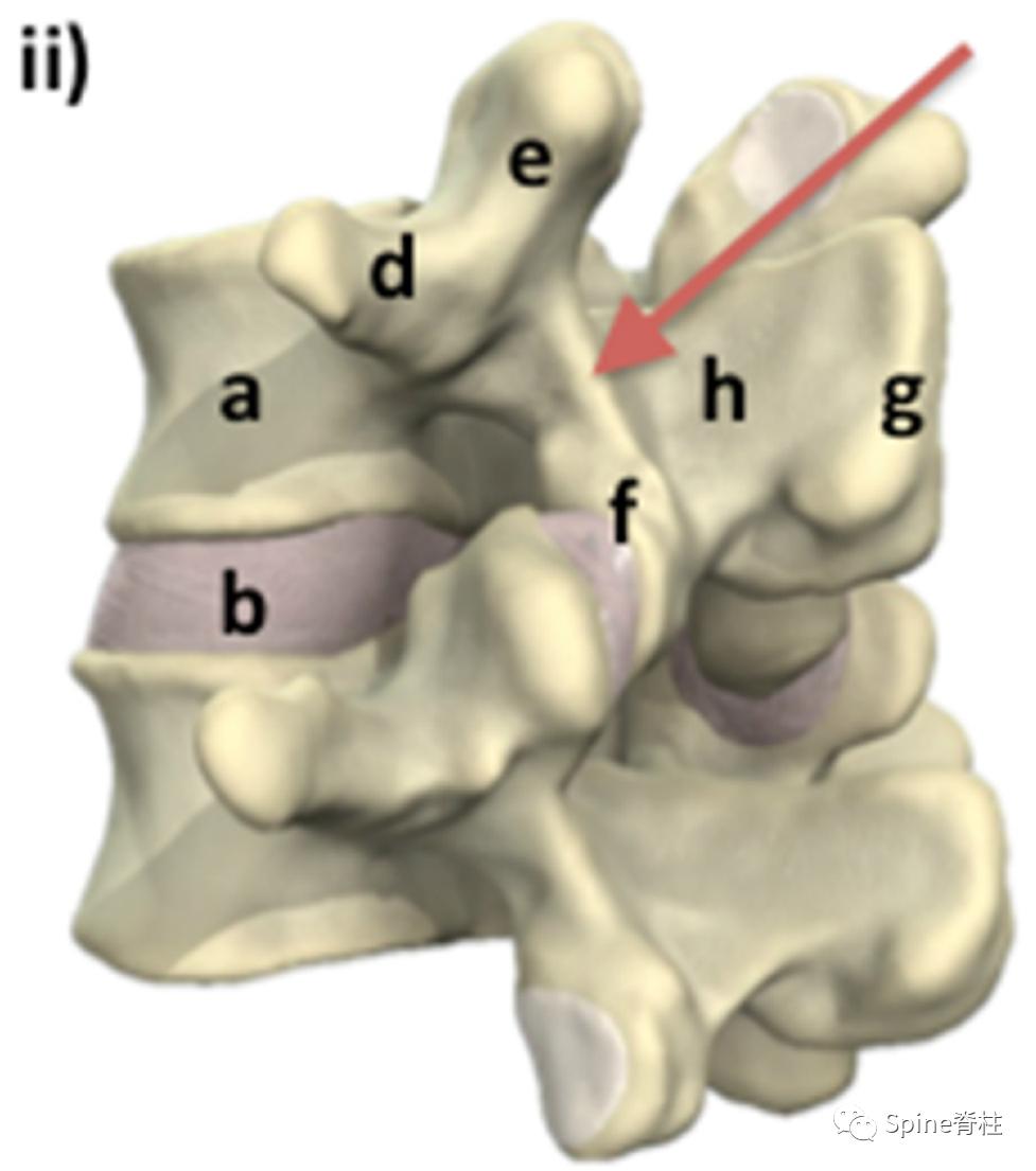 峡部裂和隐性峡部裂有区别吗,单纯峡部裂可以做峡部修复吗