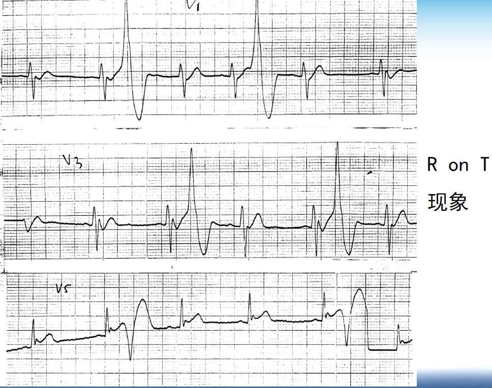 心律失常四型,心律失常四肢乏力胸口难受