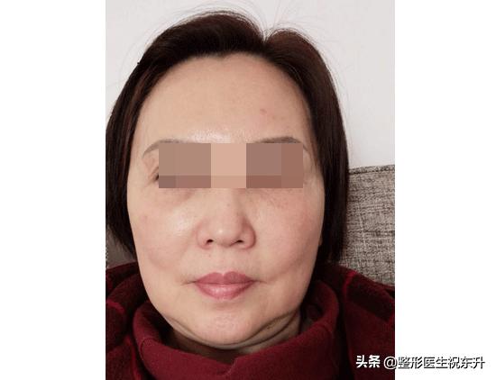 40岁能做小拉皮手术吗,50岁可以做小拉皮手术吗