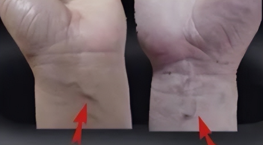 胳膊青筋手背青筋多是怎么回事,人体青筋明显是什么问题