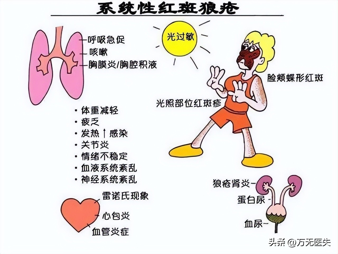 治狼疮的抗疟药,系统性红斑狼疮抗疟药