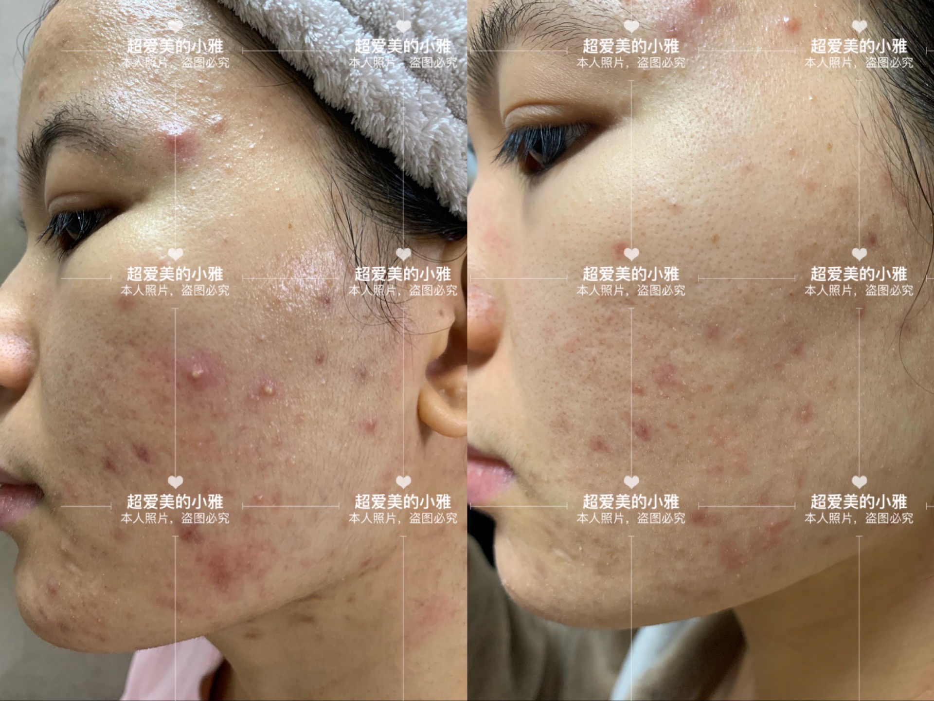 ​战胜痘痘|祛痘的加速器—针清（上）