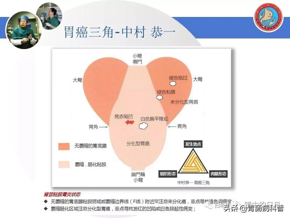 胃癌可以做内镜手术吗,早期胃癌内镜手术后追加外科手术