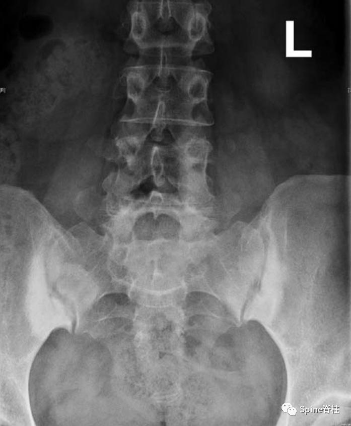 女性慢性腰痛谨防致密性髂骨炎,产后腰痛要做什么检查