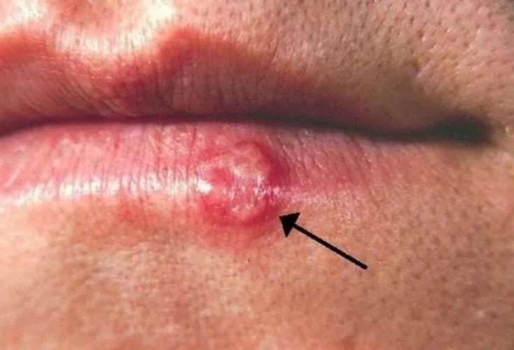 儿童嘴角突然长了一堆小水泡,5岁男童嘴角一圈泡