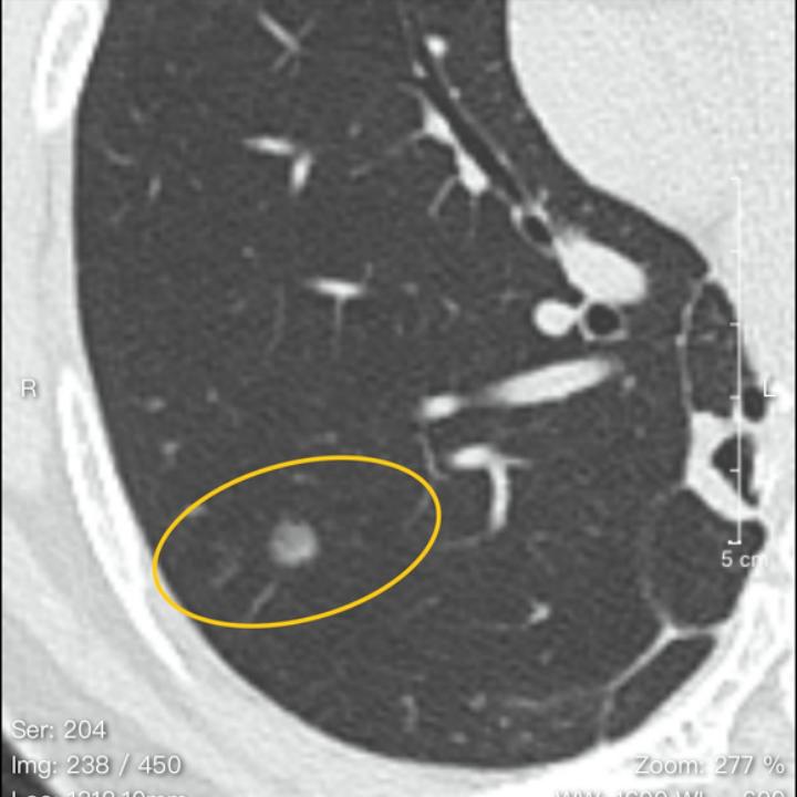 11mm混合磨玻璃结节是浸润癌概率,7mm的混合磨玻璃结节容易转癌吗