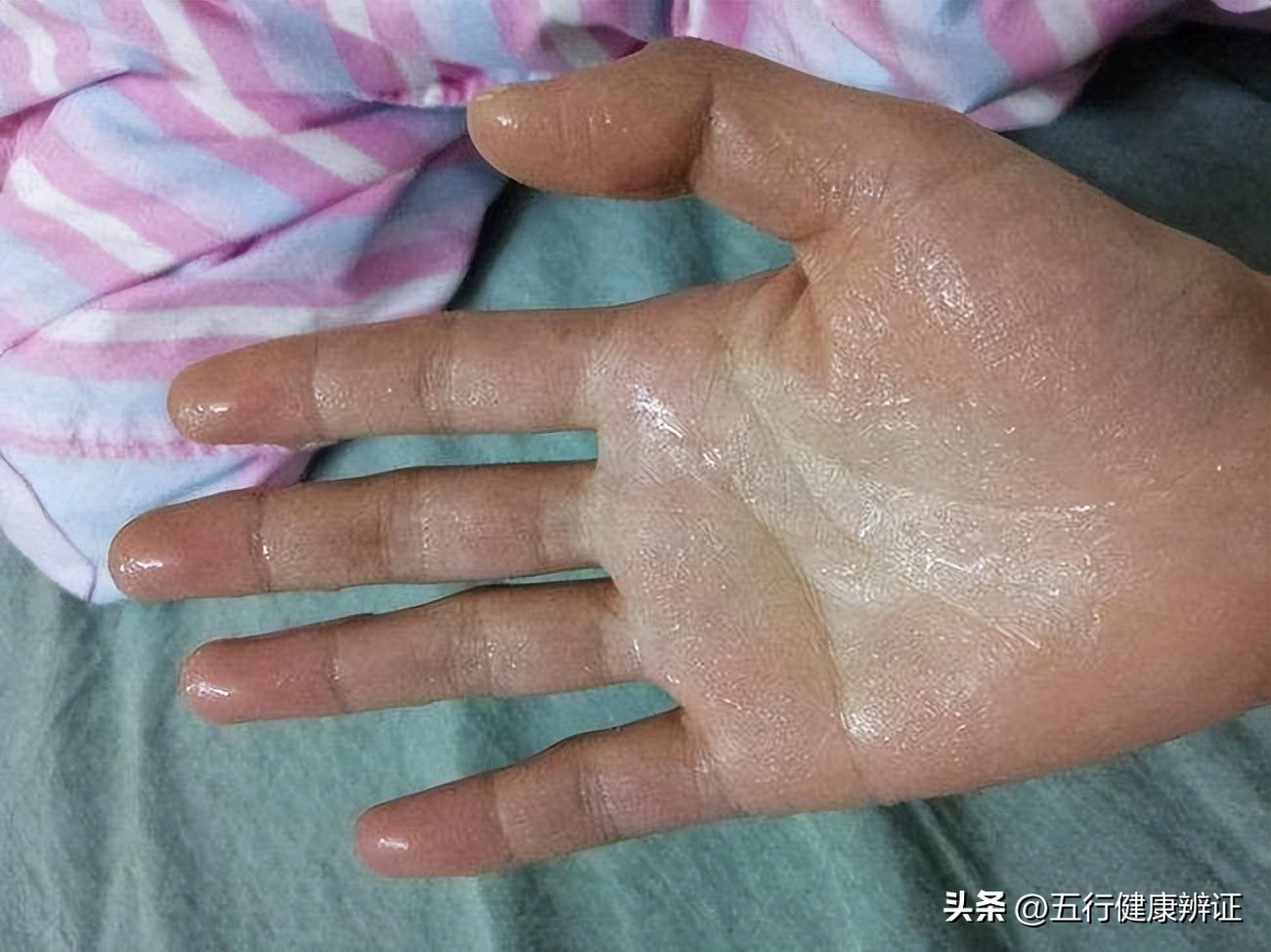 手心出汗怎么治疗最快最有效止汗,手心大量出汗问中医