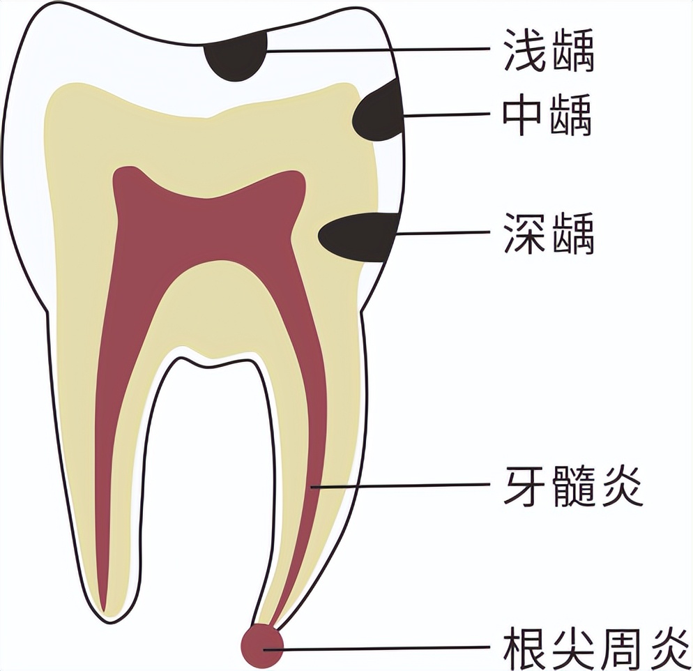 补牙后还会牙痛是正常的吗,补牙后会继续烂牙吗