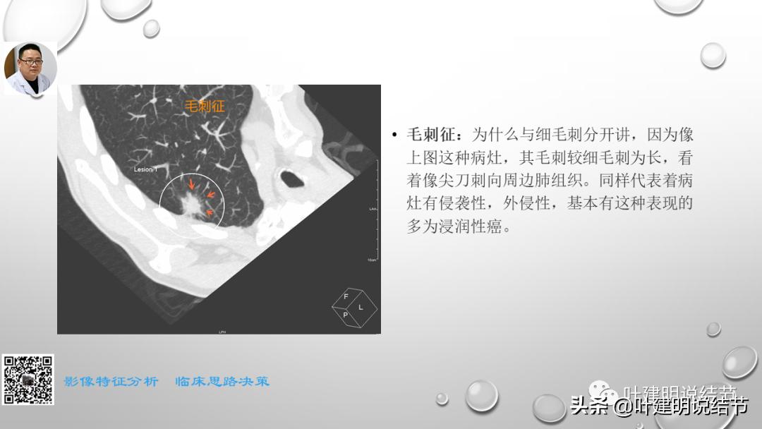 在《一脉阳光》呼吸影像诊断专题培训班上的讲课PPT（第一部分）